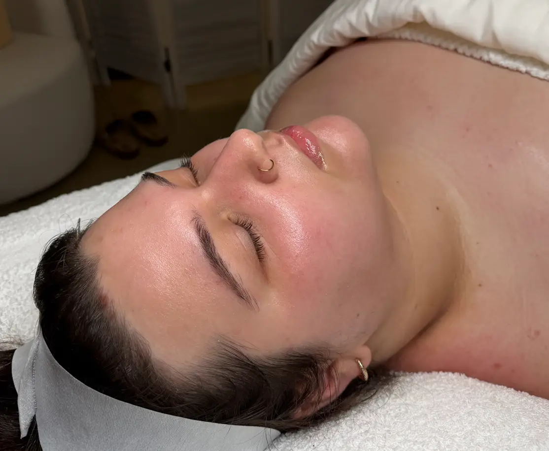 Chemical peel treatment
